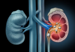 Graphic illustration of kidney stones. Dr. Evan Goldfischer specializes in the treatment and prevention of kidney stones and has had kidney stones himself.